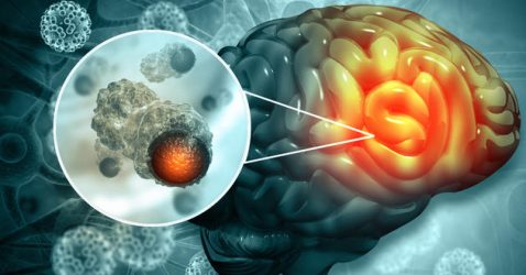 Brain Cancer: What is it, Symptoms, Diagnosis and Treatment