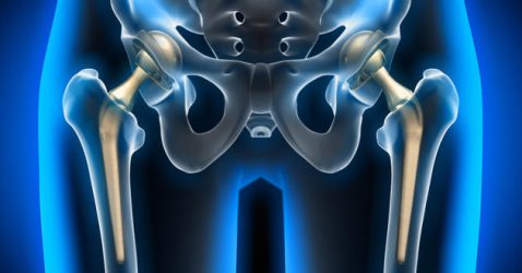Hip Replacement: What is it, Surgery, Life After Surgery