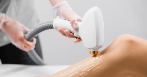What is Laser Hair Removal?  What Do You Need to Know About It?