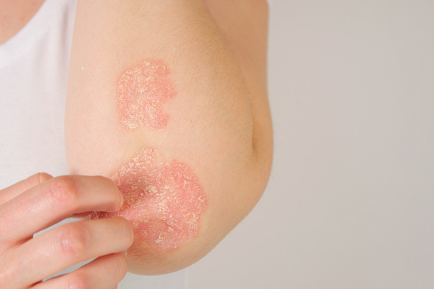 What is Psoriasis?  What are the symptoms and treatment methods?