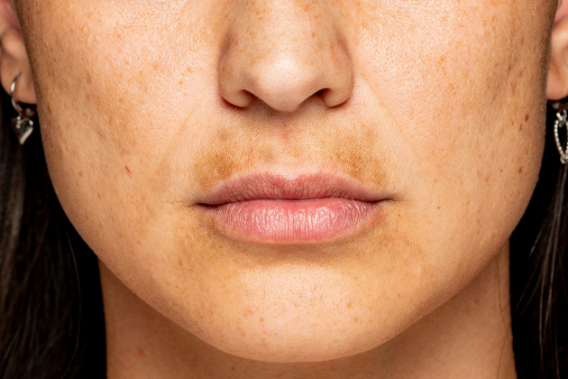How to get rid of brown spots on the body?