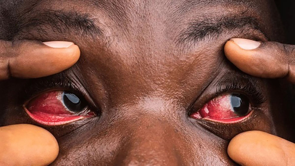 MOH Registers 954 Cases of Red Eye Outbreak