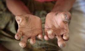 Leprosy Is Curable but Stigma Still Shapes the Global Health